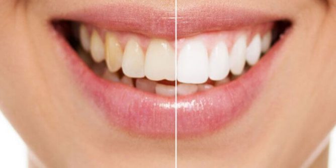 Whiten Your Teeth Naturally